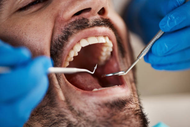 Best Emergency Dental Care for Sports Injuries in Upland, IN